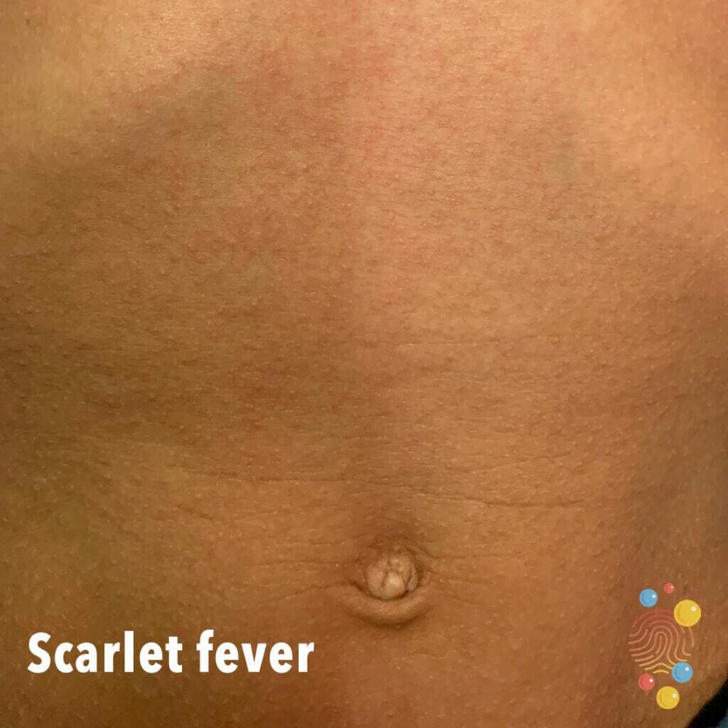 Child's tummy showing scarlet fever
